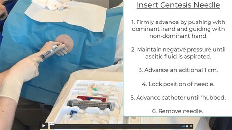 lvp paracentesis.